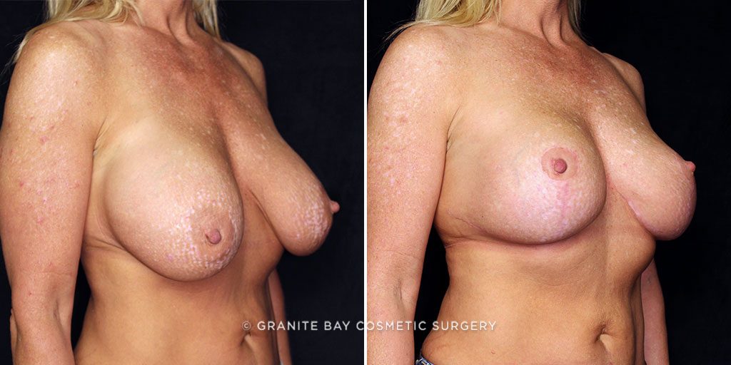 breast-implant-exchange-lift-22274b-gbc