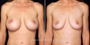breast-implant-removal-21690a-gbc