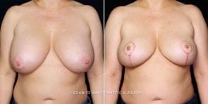 breast-implant-removal-lift-22211a-gbc