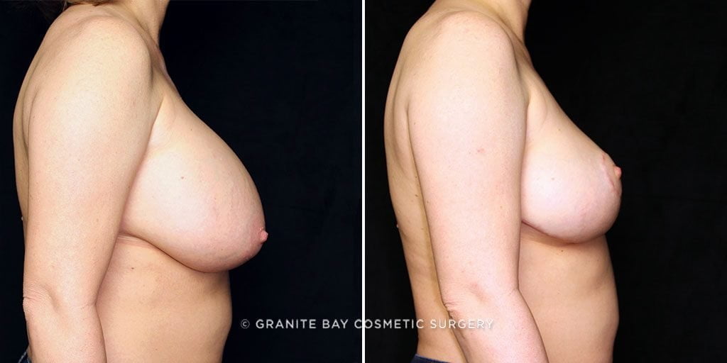 breast-implant-removal-lift-22211c-gbc