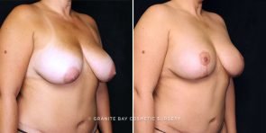breast-lift-with-implants-2120b-gbc
