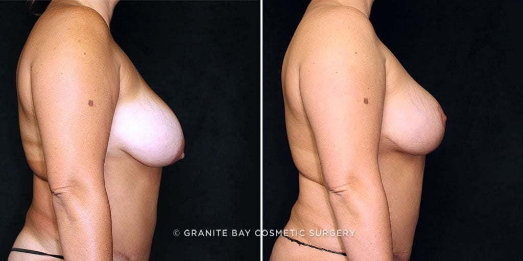 breast-lift-with-implants-2120c-gbc