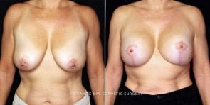 breast-lift-with-implants-22086a-gbc