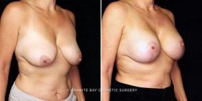 breast-lift-with-implants-22086b-gbc