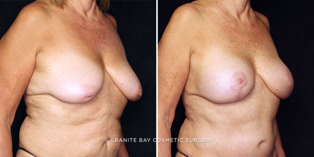 breast-lift-with-implants-22385b-gbc