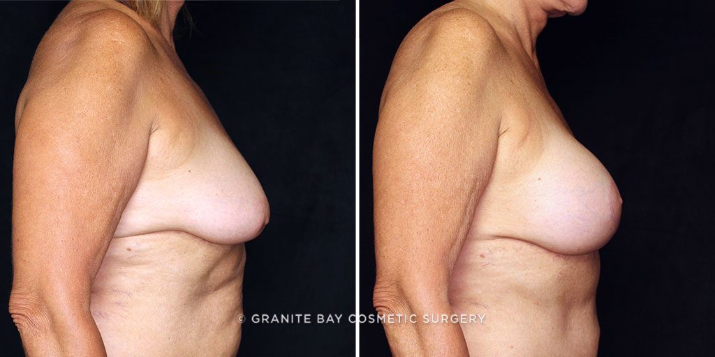 breast-lift-with-implants-22385c-gbc