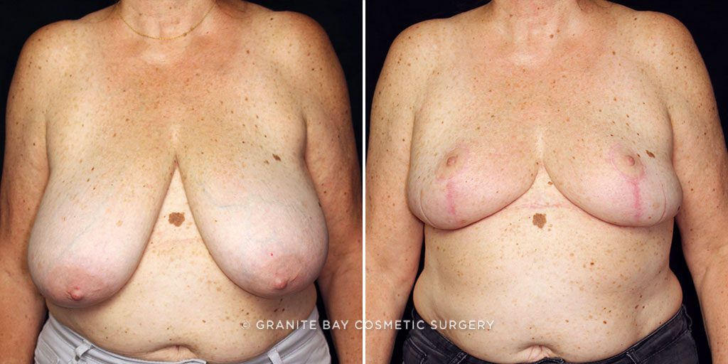 Breast Reduction
