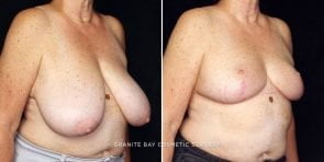 breast-reduction-22031b-gbc
