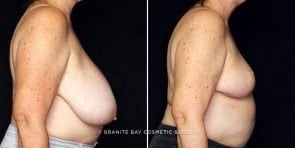 breast-reduction-22031c-gbc