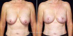 breast-reduction-22607a-gbc
