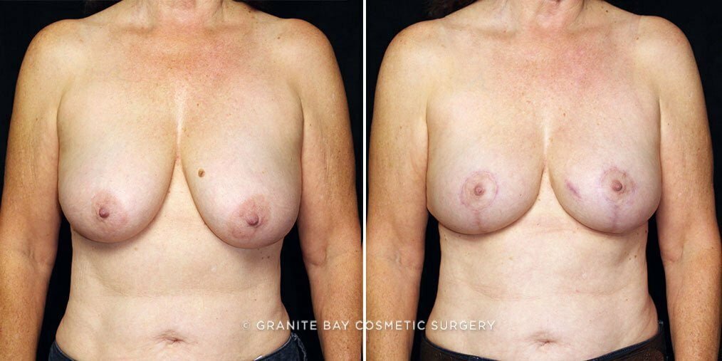 breast-reduction-22607a-gbc