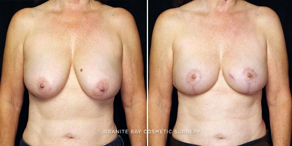 Breast Reduction