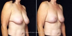 breast-reduction-22607b-gbc