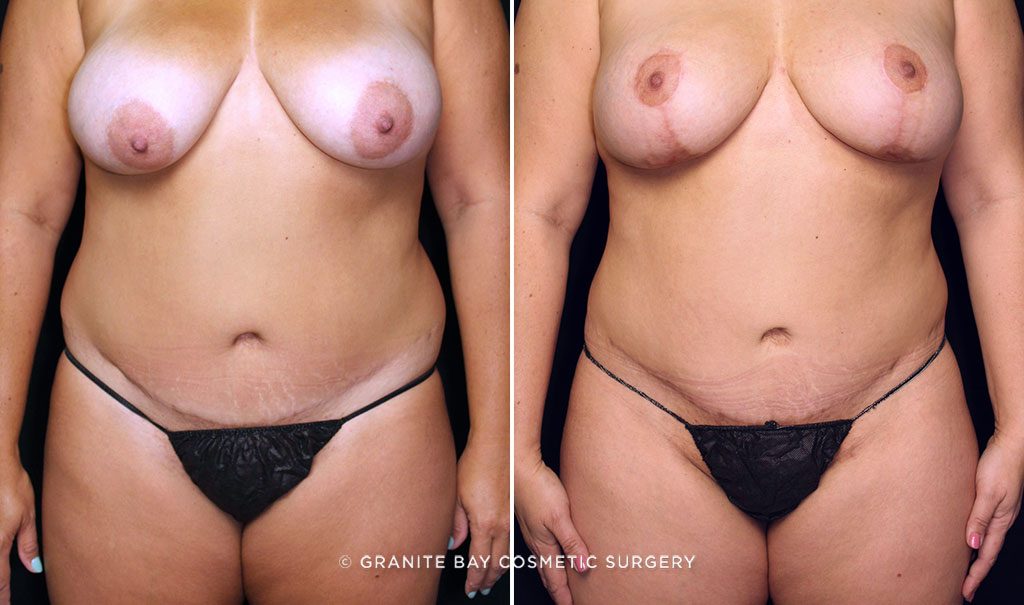 Liposuction anterior flanks, abdominoplasty scar revision