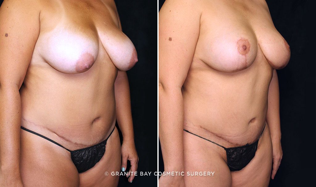 liposuction-abdominal-scar-revision-2120-b-gbc-watermarked