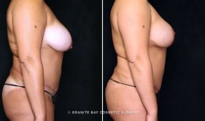 liposuction-abdominal-scar-revision-2120-c-gbc-watermarked