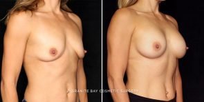 breast-augmentation-20041b-gbc