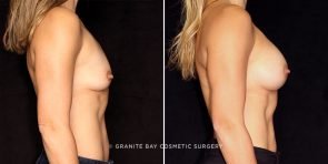 breast-augmentation-20041c-gbc
