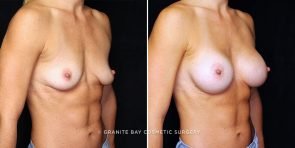breast-augmentation-22448b-gbc