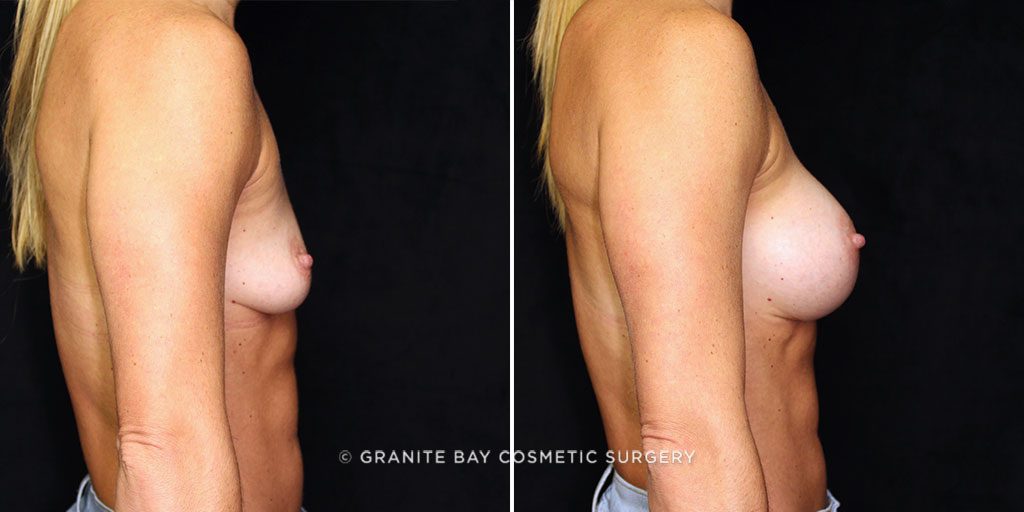 breast-augmentation-22448c-gbc