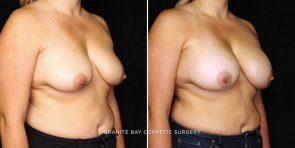 breast-augmentation-22453b-gbc