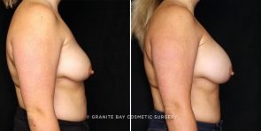breast-augmentation-22453c-gbc