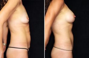 breast-augmentation-tummy-ledgectomy-22684c-gbc