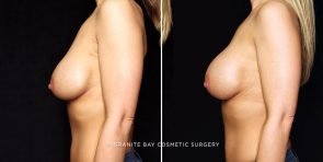 breast-implant-exchange-22444c-gbc
