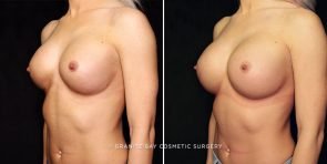 breast-implant-exchange-23094b-gbc