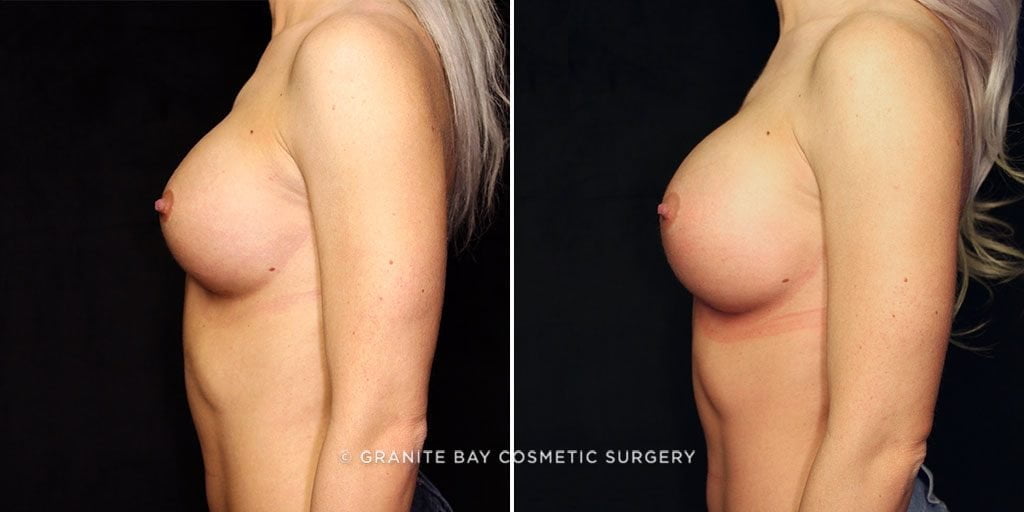 breast-implant-exchange-23094c-gbc