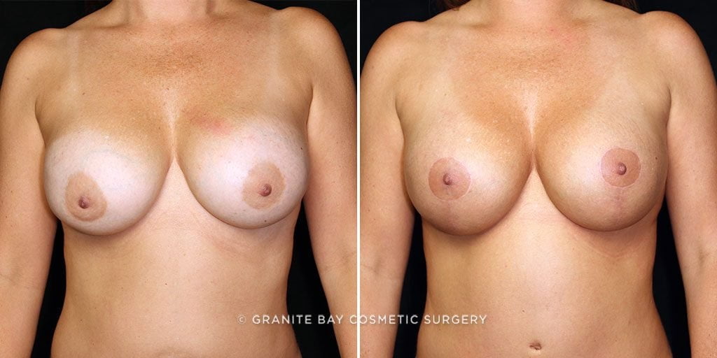 breast-implant-exchange-lift-15750a-gbc