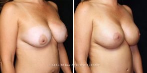 breast-implant-exchange-lift-15750b-gbc