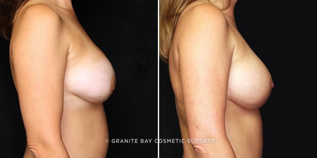 breast-implant-exchange-lift-15750c-gbc