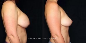 breast-implant-removal-19961c-gbc