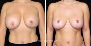 breast-implants-revision-20707a-gbc