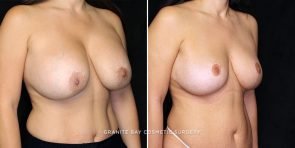 breast-implants-revision-20707b-gbc