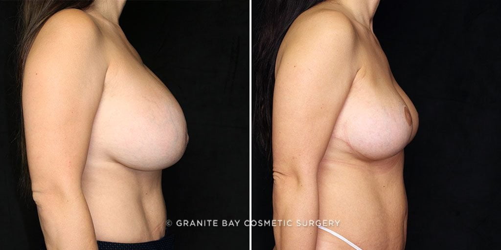 breast-implants-revision-20707c-gbc