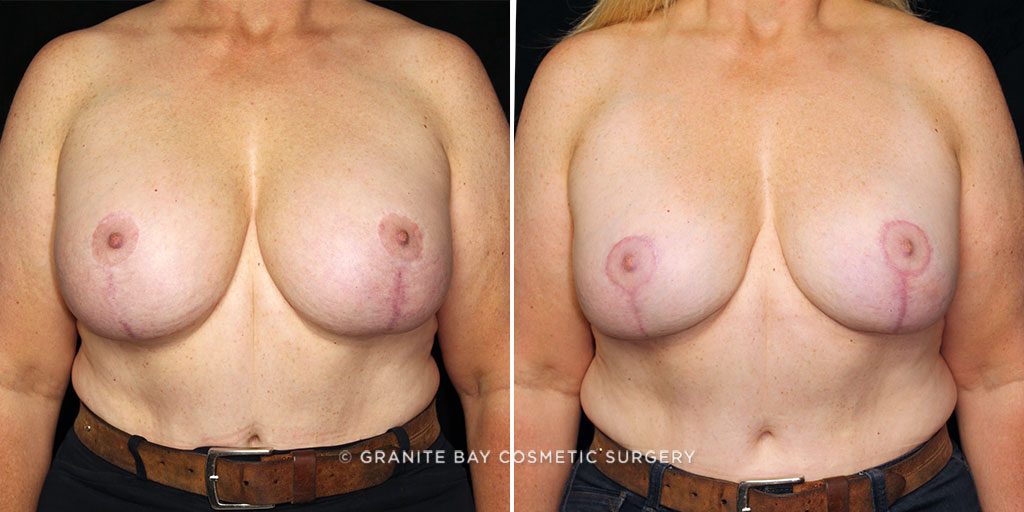 breast-revision-lift-downsize-22588a-gbc