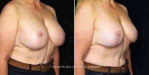 breast-revision-lift-downsize-22588b-gbc