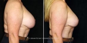 breast-revision-lift-downsize-22588c-gbc