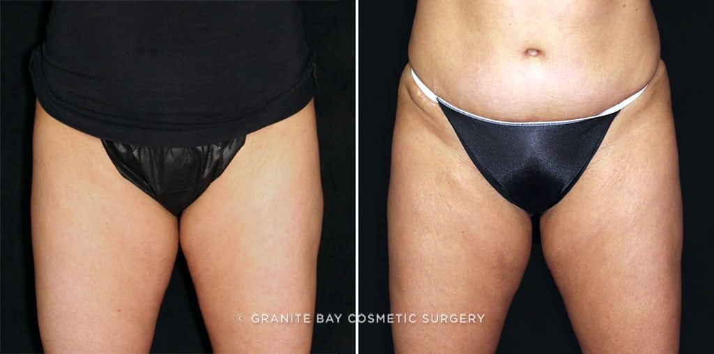 CoolSculpting Inner Thighs