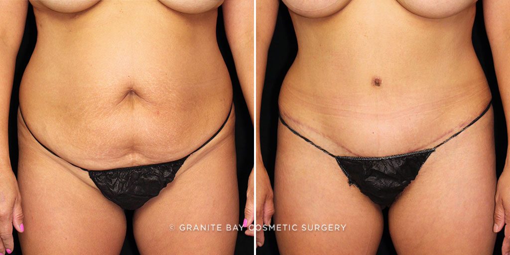 Tummy Tuck