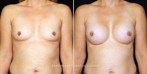 breast-augmentation-22633a-gbc