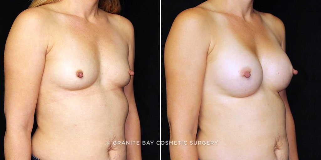 breast-augmentation-22633b-gbc