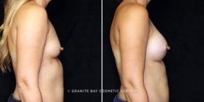 breast-augmentation-22633c-gbc