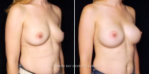 breast-augmentation-23105b-gbc