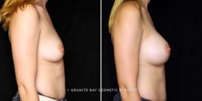 breast-augmentation-23105c-gbc
