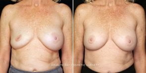 breast-implant-exchange-23003a-gbc