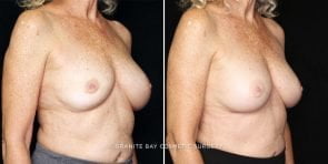breast-implant-exchange-23003b-gbc