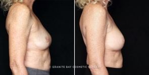 breast-implant-exchange-23003c-gbc